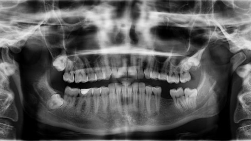 Czy wykonanie zdjęcia RTG zęba jest bezpieczne?
